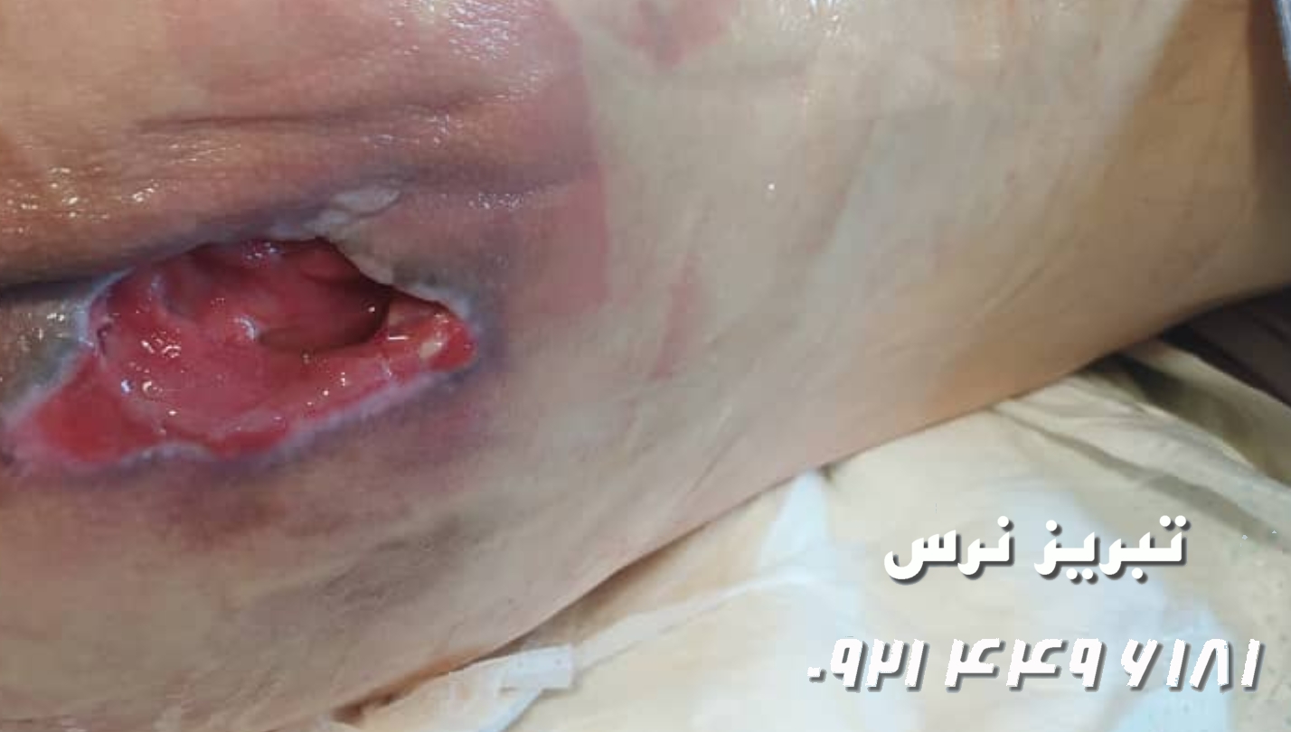 کلینیک ترمیم زخم بستر تبریز 09214496181