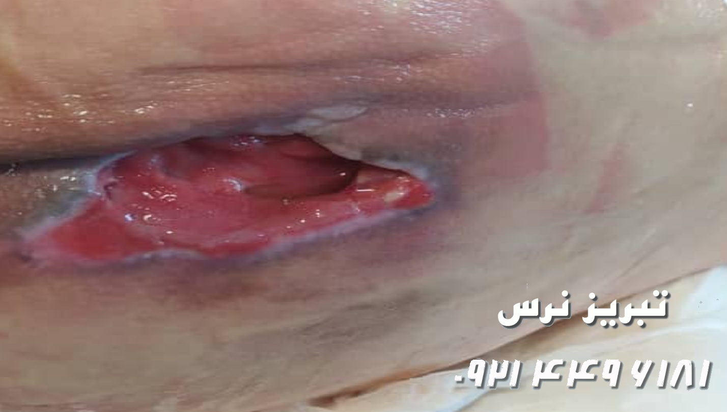 بهترین دکتر فوق تخصص زخم بستر تبریز 09214496181
