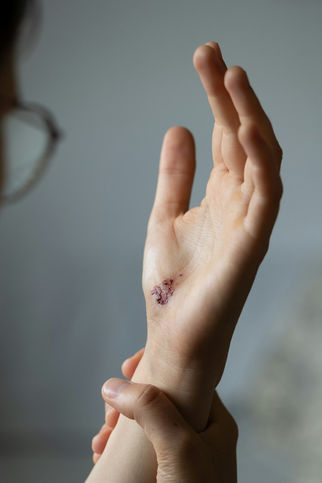 Close up of a stitched wound on a person's wrist.